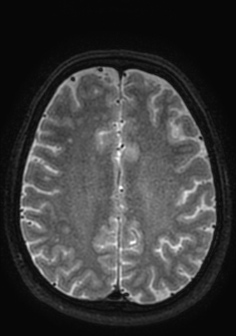 Accessory middle cerebral artery (Radiopaedia 73114-83828 Axial T2 3).jpg