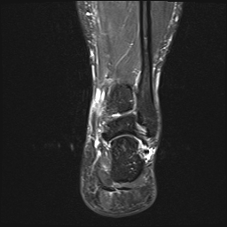File:Achilles tendon tear (Radiopaedia 77615-89819 Coronal STIR 19).jpg