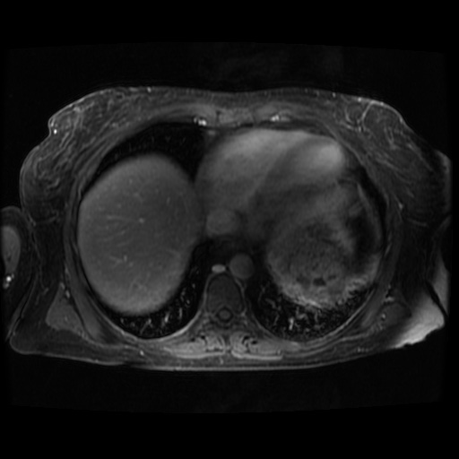Acinar cell carcinoma of the pancreas (Radiopaedia 75442-86668 Axial T1 C+ fat sat 134).jpg