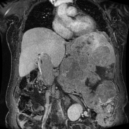 Acinar cell carcinoma of the pancreas (Radiopaedia 75442-86668 Coronal T1 C+ fat sat 113).jpg