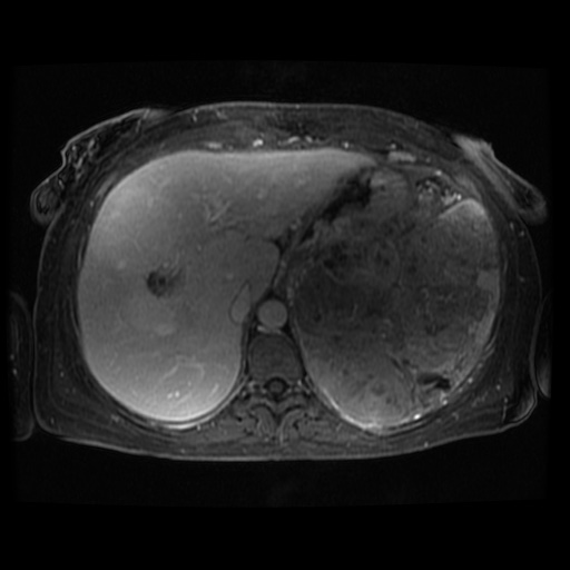 Acinar cell carcinoma of the pancreas (Radiopaedia 75442-86668 D 105).jpg