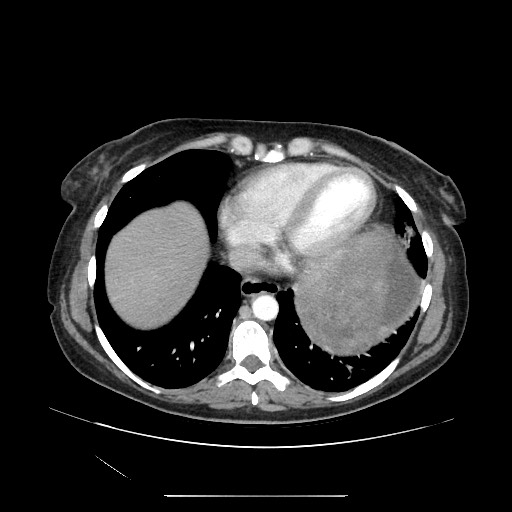 Acinar cell carcinoma of the pancreas (Radiopaedia 75442-86669 Axial C+ portal venous phase 8).jpg