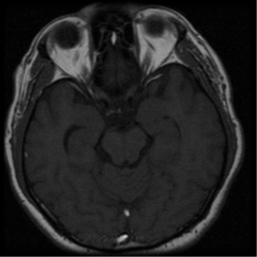 File:Acoustic schwannoma (Radiopaedia 33045-34060 Axial T1 13).png