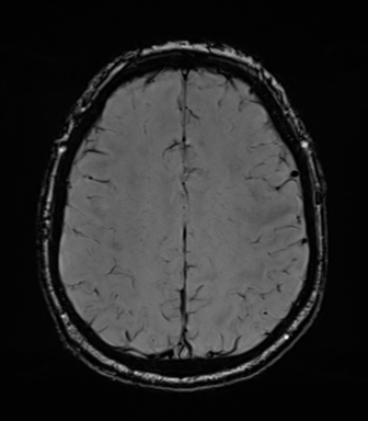 File:Acoustic schwannoma (Radiopaedia 50846-56358 Axial SWI 68).png
