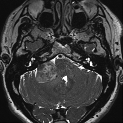File:Acoustic schwannoma (Radiopaedia 50846-56358 Axial T2 18).png