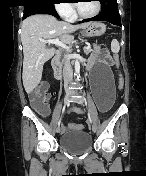 Active Crohn disease (Radiopaedia 59394-66750 Coronal C+ portal venous phase 37).jpg
