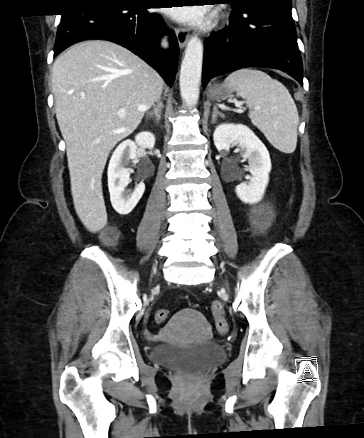 Active Crohn disease (Radiopaedia 59394-66750 Coronal C+ portal venous phase 45).jpg