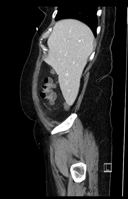 Active Crohn disease (Radiopaedia 59394-66750 Sagittal C+ portal venous phase 50).jpg