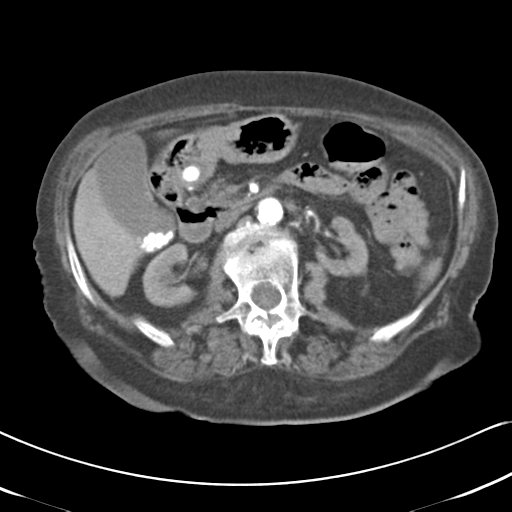 File:Active bleeding from duodenal ulcer with embolization (Radiopaedia 34216-35481 Axial C+ arterial phase 24).png