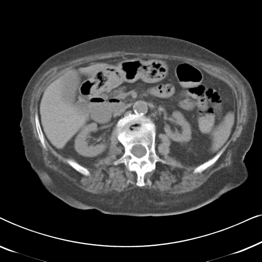 Active bleeding from duodenal ulcer with embolization (Radiopaedia 34216-35481 Axial non-contrast 25).png