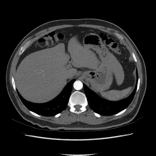 Active colonic bleed on CT (Radiopaedia 49765-55025 Axial C+ arterial phase 17).jpg