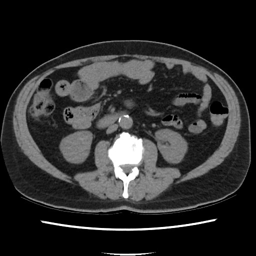 Active colonic bleed on CT (Radiopaedia 49765-55025 Axial non-contrast 38).jpg