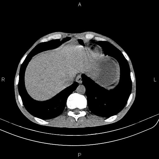 Active crohn disease (Radiopaedia 87133-103397 Axial non-contrast 11).jpg