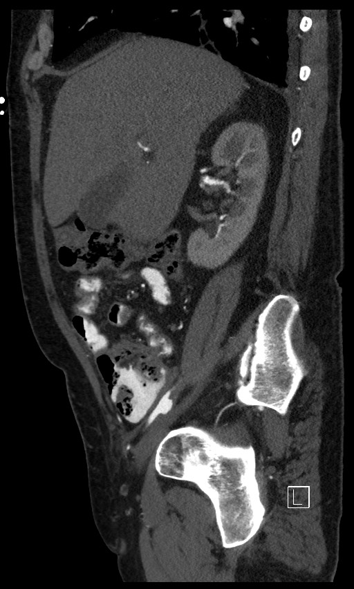 Active lower gastrointestinal bleeding - diverticular (Radiopaedia 61203-69106 Sagittal C+ arterial phase 110).jpg