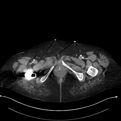 File:Active renal extravasation with large subcapsular and retroperitoneal hemorrhage (Radiopaedia 60975-68796 Axial 196).jpg