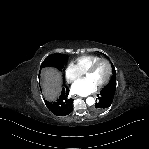 Active renal extravasation with large subcapsular and retroperitoneal hemorrhage (Radiopaedia 60975-68796 Axial C+ arterial phase 12).jpg