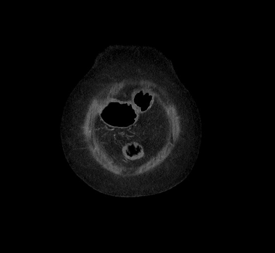 Active renal extravasation with large subcapsular and retroperitoneal hemorrhage (Radiopaedia 60975-68796 Coronal C+ arterial phase 18).jpg