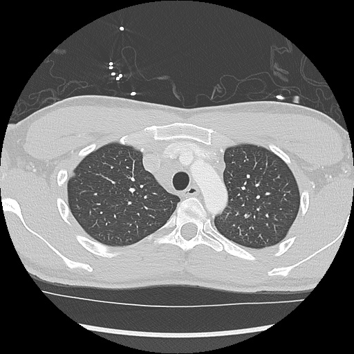 File:Active right ventricular cardiac sarcoidosis (Radiopaedia 55596-62101 Axial lung window 6).jpg