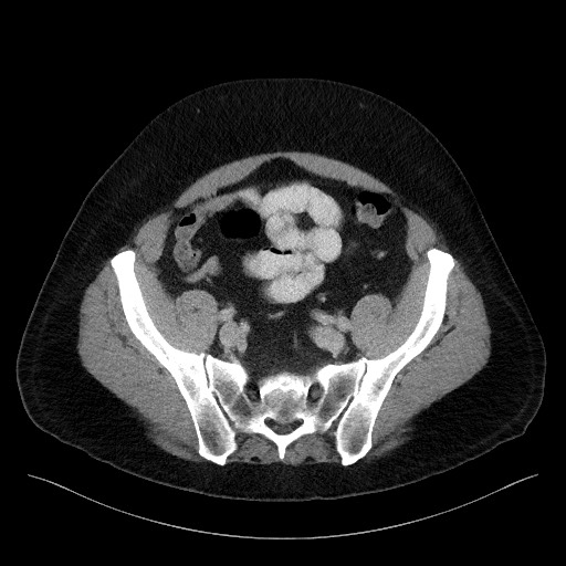 Acute-on-chronic pancreatitis (Radiopaedia 67286-76656 Axial C+ portal venous phase 62).jpg