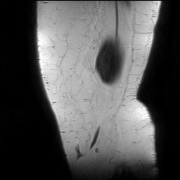 File:Acute-on-chronic transient lateral patellar dislocation with trochlear dysplasia (Radiopaedia 84099-99349 Sagittal PD 7).jpg