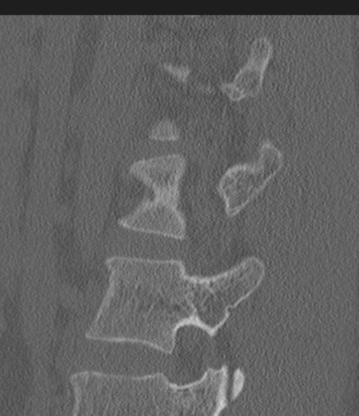 File:Acute L1 burst compression fracture (Radiopaedia 34430-35755 Sagittal bone window 46).png