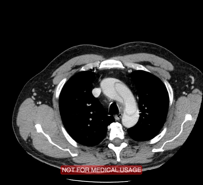 Acute aortic dissection - Stanford type A (Radiopaedia 40661-43285 Axial C+ portal venous phase 4).jpg
