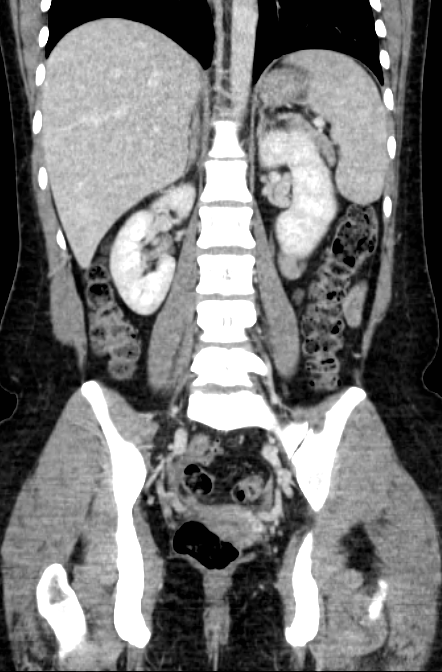 Acute appendicitis (Radiopaedia 22892-22918 Coronal C+ portal venous phase 35).png