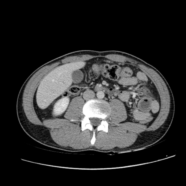 Acute appendicitis (Radiopaedia 27049-27227 Axial C+ portal venous phase 37).jpg