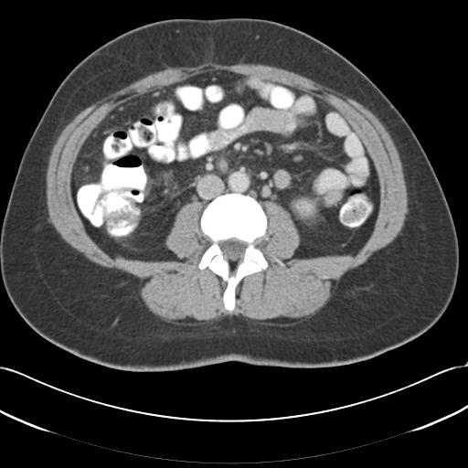 Acute appendicitis (Radiopaedia 30297-30934 Axial C+ portal venous phase 43).jpg