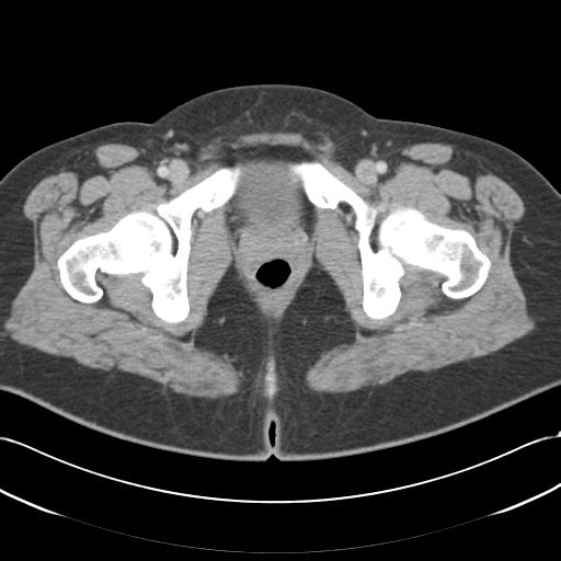 Acute appendicitis (Radiopaedia 30297-30934 Axial C+ portal venous phase 81).jpg