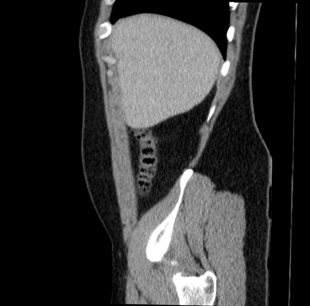 Acute appendicitis (Radiopaedia 38255-40270 Sagittal C+ portal venous phase 14).jpg
