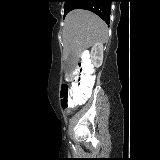 File:Acute appendicitis (Radiopaedia 52672-58589 Sagittal C+ arterial phase 25).jpg