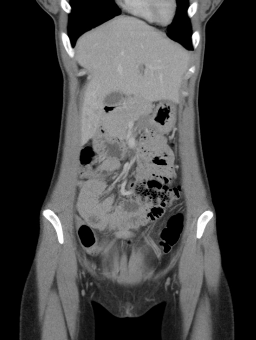 Acute appendicitis (Radiopaedia 62608-70901 Coronal C+ portal venous phase 8).jpg