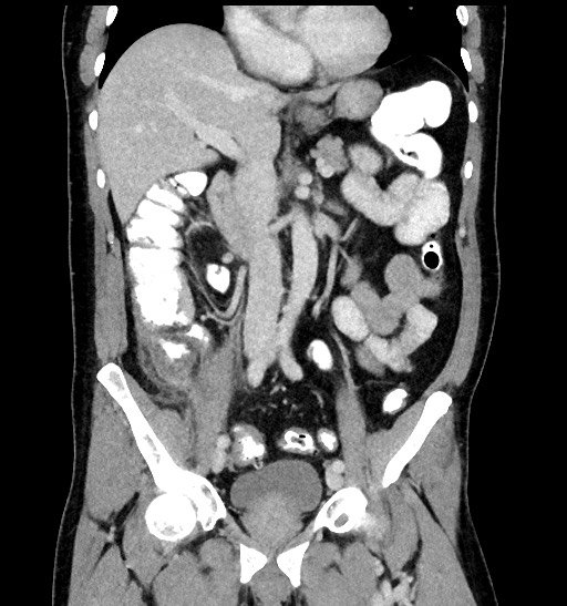 Acute appendicitis (Radiopaedia 77016-88960 Coronal C+ portal venous phase 50).jpg