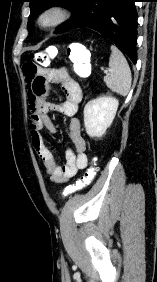 Acute appendicitis (Radiopaedia 77016-88960 Sagittal C+ portal venous phase 26).jpg