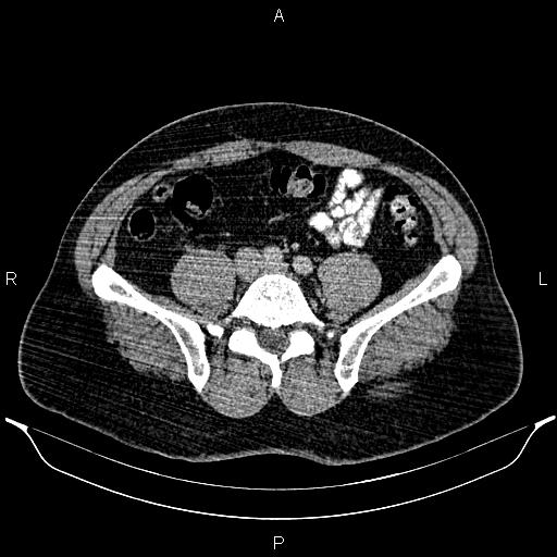 Acute appendicitis (Radiopaedia 84780-100240 Axial C+ portal venous phase 74).jpg