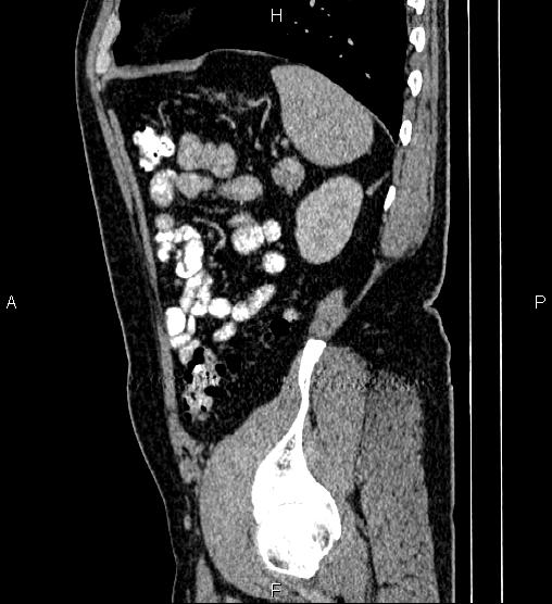 Acute appendicitis (Radiopaedia 84780-100240 Sagittal C+ portal venous phase 84).jpg