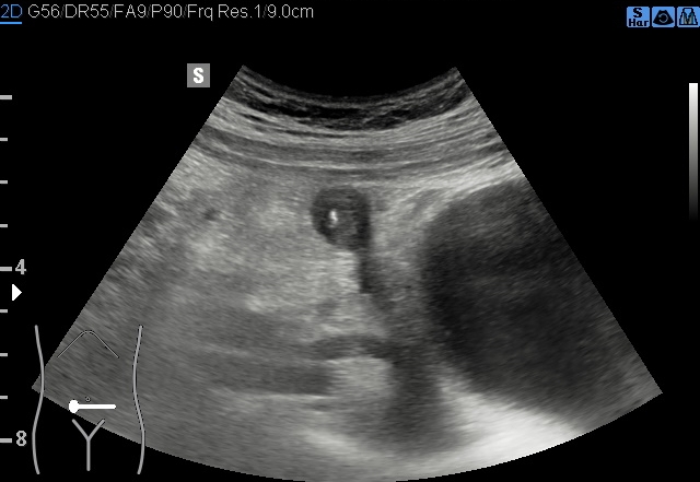 File:Acute appendicitis (Radiopaedia 85193-100745 B 110).jpg