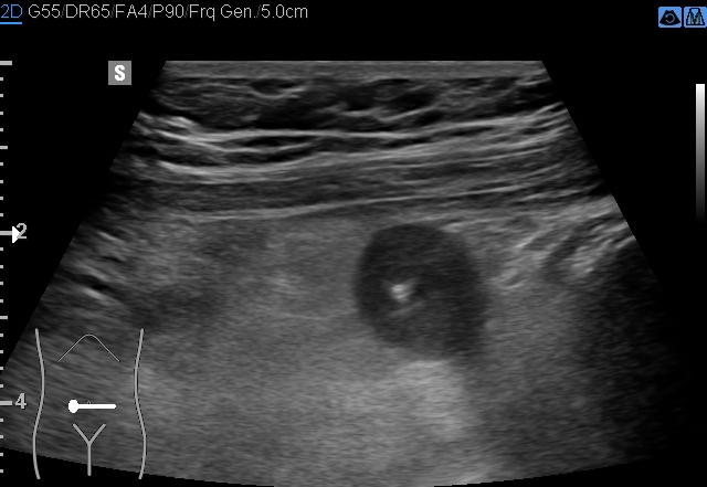 File:Acute appendicitis (Radiopaedia 85193-100745 D 172).jpg