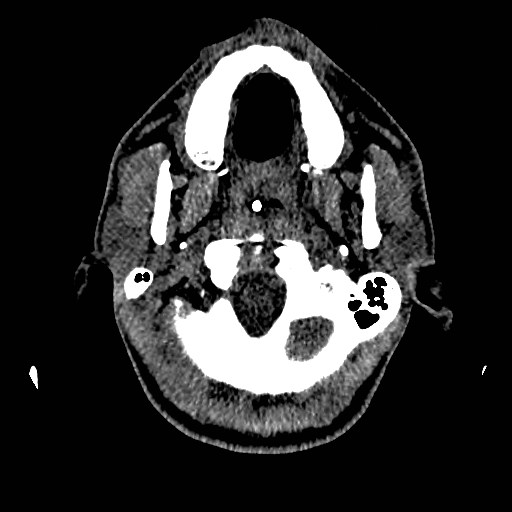 Acute basilar artery occlusion (Radiopaedia 43582-46985 Axial non-contrast 26).jpg