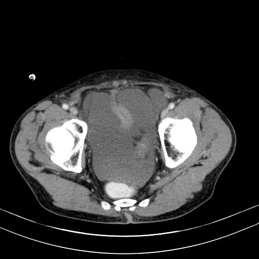 Acute bowel ischemia (Radiopaedia 87695-104114 Axial C+ portal venous phase 78).jpg