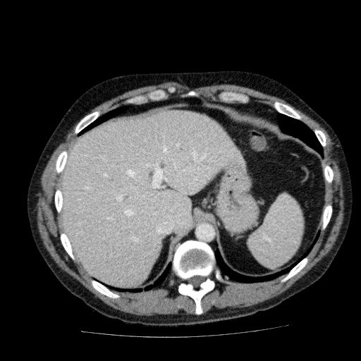 Acute cholecystitis and incidental left sided IVC (Radiopaedia 49352-54459 Axial C+ portal venous phase 37).jpg