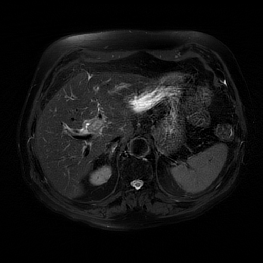 File:Acute cholecystitis complicated by pylephlebitis (Radiopaedia 65782-74915 Axial T2 fat sat 16).jpg