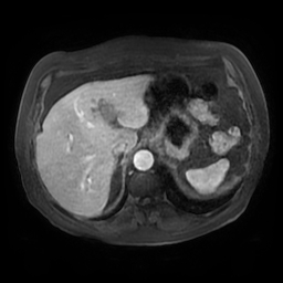 Acute cholecystitis complicated by pylephlebitis (Radiopaedia 65782-74915 Axial arterioportal phase T1 C+ fat sat 30).jpg
