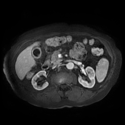 Acute cholecystitis complicated by pylephlebitis (Radiopaedia 65782-74915 Axial arterioportal phase T1 C+ fat sat 77).jpg