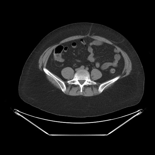 Acute cholecystitis with tensile fundus sign (Radiopaedia 71394-81723 Axial non-contrast 72).jpg