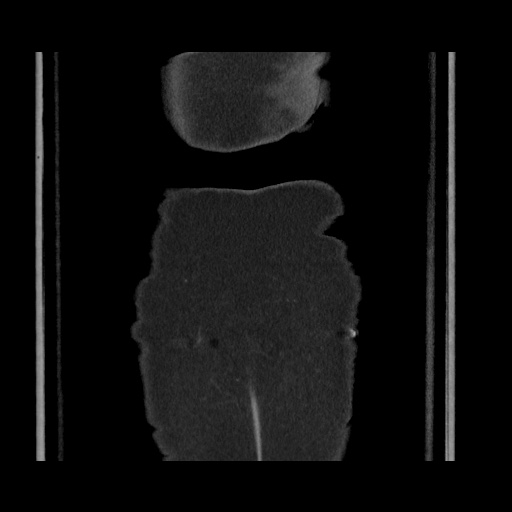Acute cholecystitis with tensile fundus sign (Radiopaedia 71394-81723 Coronal non-contrast 126).jpg