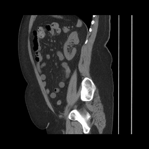 Acute cholecystitis with tensile fundus sign (Radiopaedia 71394-81723 Sagittal non-contrast 113).jpg