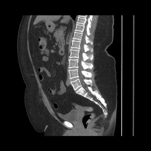 File:Acute cholecystitis with tensile fundus sign (Radiopaedia 71394-81723 Sagittal non-contrast 88).jpg