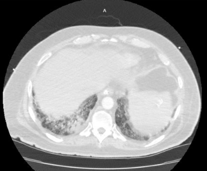 File:Acute cor pulmonale (ultrasound) (Radiopaedia 83508-98818 Axial lung window 73).jpg